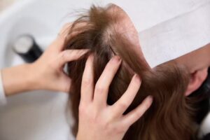 Close-up of hands parting brown hair to inspect the scalp in a clinical setting